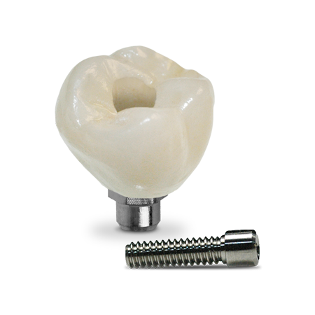 Screw-Retained Crown